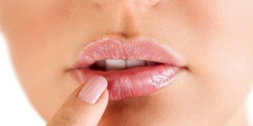 Herpes labial