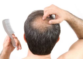 ¿Cómo puedo saber si me voy a quedar calvo?