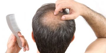 ¿Cómo puedo saber si me voy a quedar calvo?