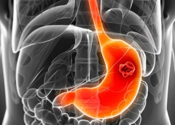 Esto es lo que debes saber sobre prevención del cáncer de estómago