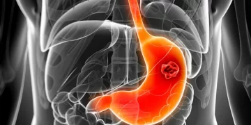 Esto es lo que debes saber sobre prevención del cáncer de estómago