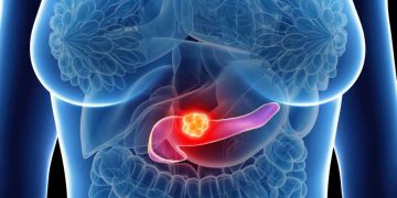 Avances en cáncer de páncreas: investigación para tratarlo antes y mejor