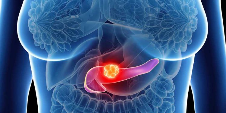 Avances en cáncer de páncreas: investigación para tratarlo antes y mejor