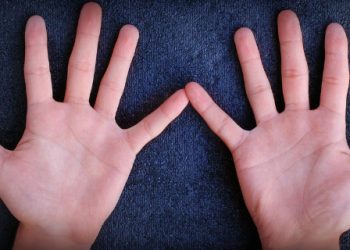 Dedos torcidos o doblados, ¿a qué puede deberse?