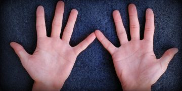 Dedos torcidos o doblados, ¿a qué puede deberse?