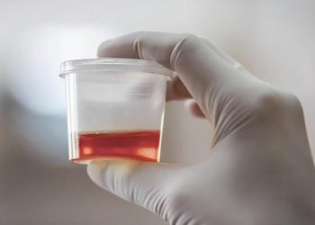 Sangre en la orina o hematuria: estas son las causas