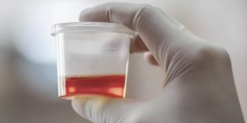 Sangre en la orina o hematuria: estas son las causas