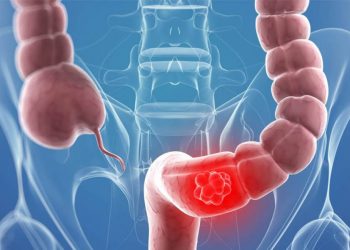 Cáncer de colon