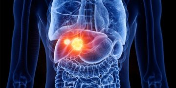 Cómo prevenir y diagnosticar a tiempo el cáncer de hígado