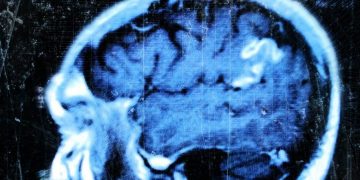 ¿Qué ocurre en el cerebro de una persona con depresión?