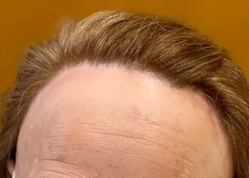 Alopecia frontal fibrosante: la calvicie de la diadema