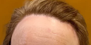 Alopecia frontal fibrosante: la calvicie de la diadema