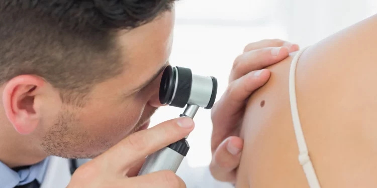 Decálogo para prevenir el melanoma maligno