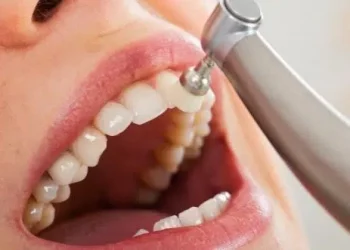 ¿Hacerse muchas limpiezas dentales desgasta los dientes?