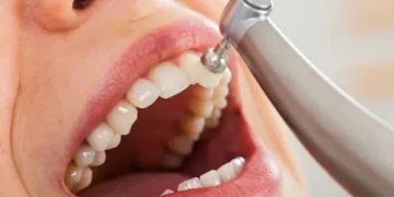 ¿Hacerse muchas limpiezas dentales desgasta los dientes?