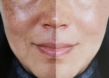 ¿Cuál es el mejor tratamiento de las manchas hormonales o melasma?