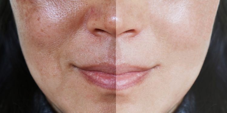 ¿Cuál es el mejor tratamiento de las manchas hormonales o melasma?
