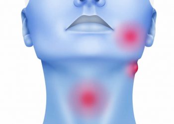 Cáncer de cabeza y cuello