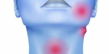 Cáncer de cabeza y cuello