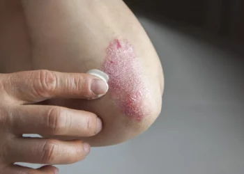 Psoriasis