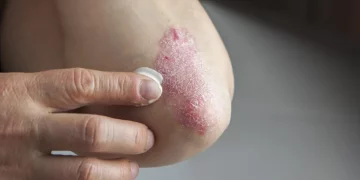 Psoriasis