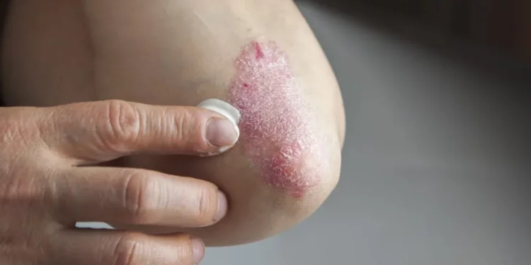 Psoriasis