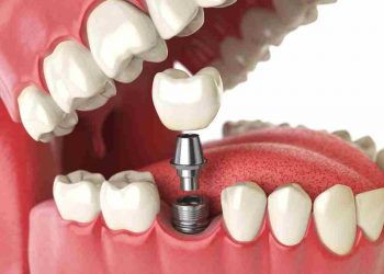Implantes dentales: así hay que cuidarlos, según los odontológos