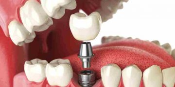 Implantes dentales: así hay que cuidarlos, según los odontológos