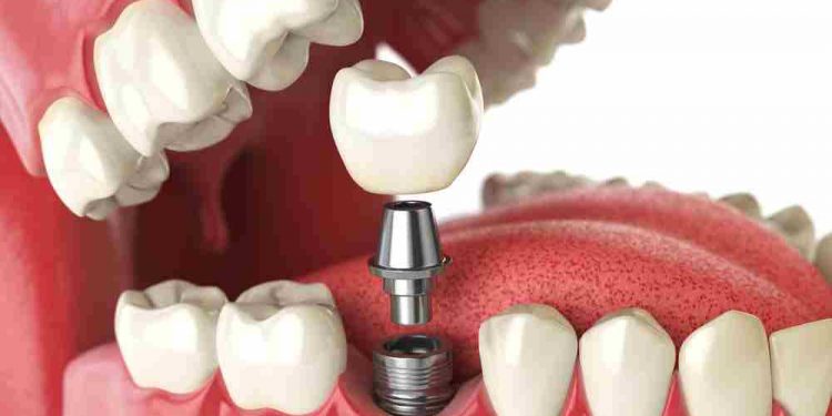 Implantes dentales: así hay que cuidarlos, según los odontológos