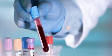 Cuatro biomarcadores y un fármaco podrían redefinir el tratamiento de la diabetes