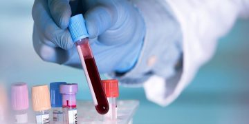 ¿Y si el Parkinson se pudiese diagnosticar con un análisis de sangre?