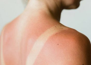 Piel pelada por el sol: no te la quites, esto es lo que debes hacer