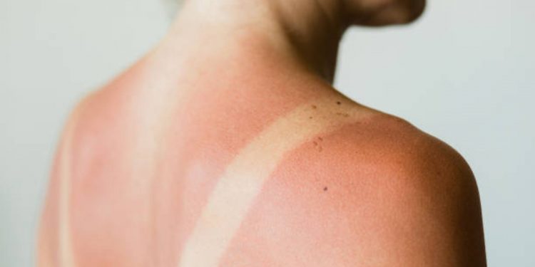 Piel pelada por el sol: no te la quites, esto es lo que debes hacer