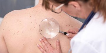 ¿Sabías que el cáncer de piel es mucho más que el melanoma o el carcinoma?