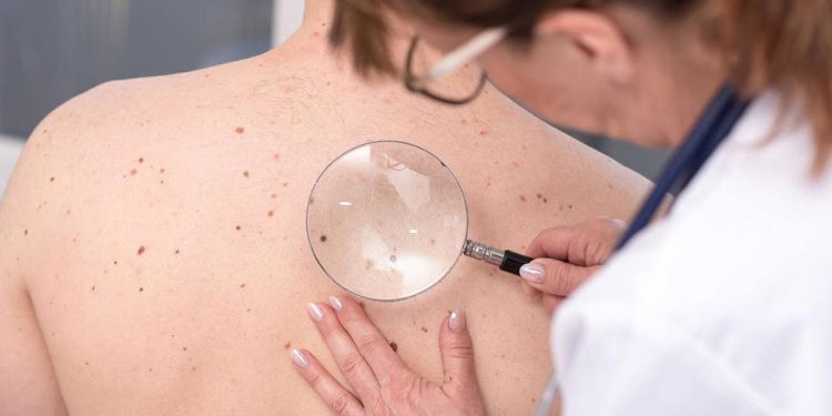 ¿Sabías que el cáncer de piel es mucho más que el melanoma o el carcinoma?