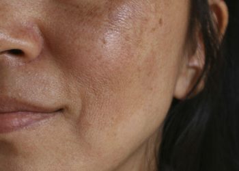 Diez falsos mitos sobre las manchas