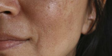 Diez falsos mitos sobre las manchas