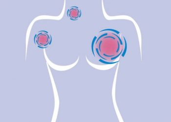Las mujeres deben saber sobre su riesgo de cáncer de mama