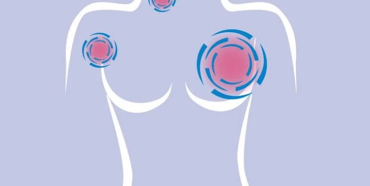 Las mujeres deben saber sobre su riesgo de cáncer de mama
