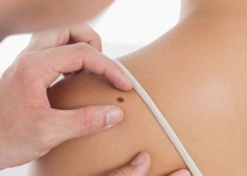Los 5 signos que sugieren que tienes un cáncer de piel