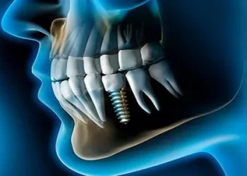¿Duelen los implantes dentales?