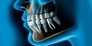 ¿Duelen los implantes dentales?