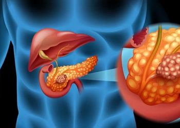 Estas personas tienen más riesgo de sufrir cáncer de páncreas, según la ciencia