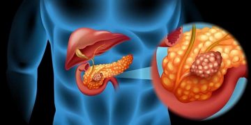 Estas personas tienen más riesgo de sufrir cáncer de páncreas, según la ciencia