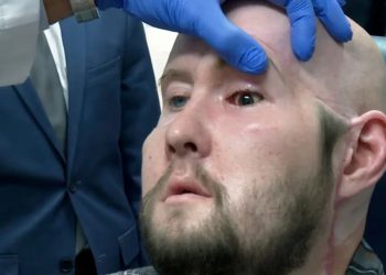 Hombre recibe con éxito el primer trasplante de ojo completo en el mundo