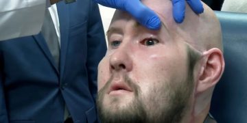 Hombre recibe con éxito el primer trasplante de ojo completo en el mundo