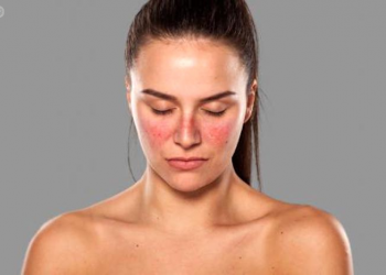 5 datos clave para entender el lupus