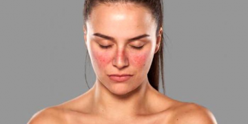 5 datos clave para entender el lupus