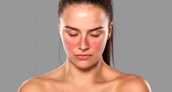 5 datos clave para entender el lupus