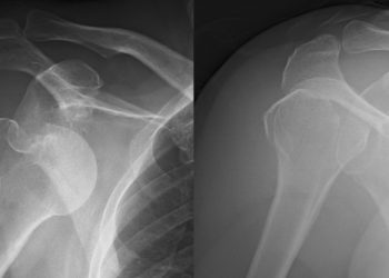 Hombro dislocado, ¿qué ejercicios hacer para recuperarme?